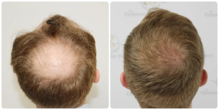 Covrix™ Hair Growth System + Free Scalp Massager