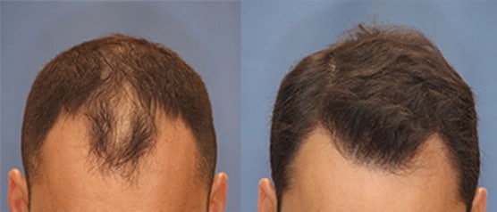 Covrix™ Hair Growth System + Free Scalp Massager